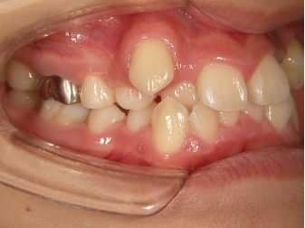 高校一年生女の子乱杭歯 歯列の幅が狭く 八重歯 でこぼこがある状態 永久歯列の抜歯治療 凸凹 八重歯 V字型歯列 とし歯科クリニック矯正 歯科 小児歯科
